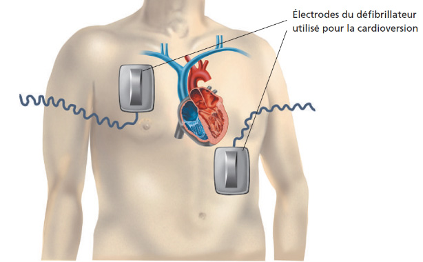 Cardioversion électrique externe Lyon  CCJJ - Centre Cardiovasculaire Jean  Jaurès